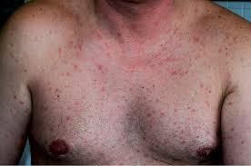 If the hiv rash is the result of antiviral medications, the rash will appear as raised reddish lesions yes, hsv does not protect against hiv. Human Herpesvirus 7 Papular Rash In A Healthy Adult Patient Html Acta Dermato Venereologica