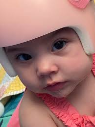 My little girls cranial helmet