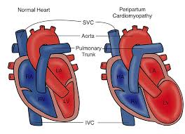 Image result for Cardiomyopathy