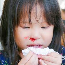 Sebaliknya, mama kena suruh anak bertenang, duduk, bernafas melalui mulut dan seterusnya picit. Hidung Berdarah Ini Cara Hentikan Pendarahan May 2021 Kelabmama Malaysia