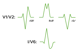 Image result for Right Bundle Branch Block