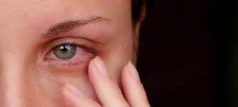 Red eye usually is a symptom of other eye conditions that can range from benign to serious. Most Common Causes Of Bloodshot Eyes Feel Good Contacts Uk