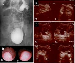 Image result for Voiding Cystourethrogram