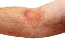 We generally list the highest rated and both men and women can use these lotions, creams and products to relieve their dry, itchy skin, eczema, psoriasis, rashes, and other skin conditions. Eczema Treatment Putting Honey On Your Skin Could Slash Symptoms And Reduce Itchy Rash Express Co Uk