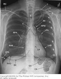 How to read a normal chest x ray: 15 Imaging Studies Clinicians Pocket Reference 11th Edition Radiology Student Emergency Medicine Radiology