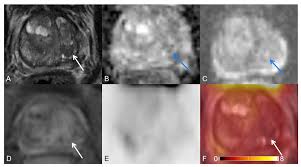 Prostate cancer basics gives an overview of this common type of cancer. Cancers Free Full Text Correlation Between Intraprostatic Psma Uptake And Mri Pi Rads Of 68ga Ga Psma 11 Pet Mri In Patients With Prostate Cancer Comparison Of Pi Rads Version 2 0 And Pi Rads Version 2 1 Html