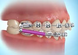 Maybe you would like to learn more about one of these? Forsus Springs A Patient S Guide Premier Orthodontics
