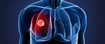 Three survivors with no history of smoking share the signs that led to a diagnosis they never expected. Lung Cancer Statistics World Cancer Research Fund International