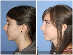 Before And After Rhinoplasty Gallery Nose Surgery Rhinoplasty Cosmetic Surgeon Rhinoplasty Nose Jobs