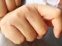 Image result for Dry Skin