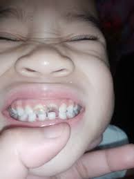 Analyzed natin ito... Rebond ang Buhok, naka eyelash extension at nail  Extension in short Maganda basta di tumawa kase ganito ang Ngipin niya.  Okey lang ba Ganito kahalikan mo knowing yung bacteria