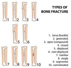 Pin By Andres Sanchez On Orthopedics Types Of Bones Bone Fracture Bones