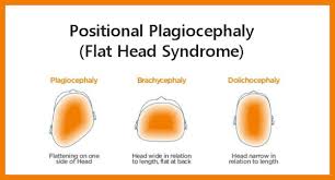 Image result for Positional Head Deformity