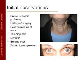 Hyperthyroidism, overactive thyroid, may cause anything from weight loss to. Thyroid Disease Case Thyroid Disease Asa Ps Level Algorithm Ppt Video Online Download