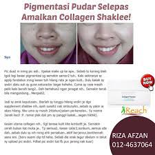 Dengan cara yang paling alami, tradisional, tanpa efek samping, obat kimia atau operasi plastik, dan yang terpenting murah meriah. Cara Menghilangkan Sunburn Guna Bahan Semulajadi Yang Boleh Dibeli Di Pasar Je