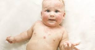 Ausschlag Beim Baby