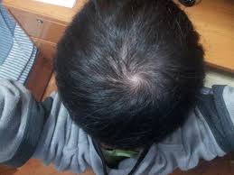 While it can be hugely distressing, male pattern baldness strikes the majority of us men. Is It Thinning On My Crown Open Hair Loss Topics Hair Restoration Network Community For And By Hair Loss Patients