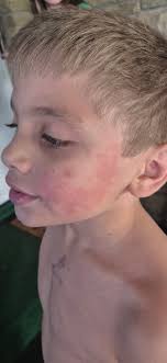 Anyone one heard of a baby being "hivey"? And no it's not a rash.