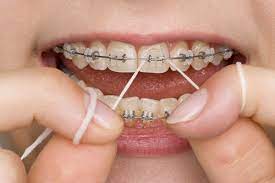 1/21/2020 braces do amazing things for your smile, but they require a lot of hard work. 5 Top Tips To Keep Your Teeth Clean If You Have Braces