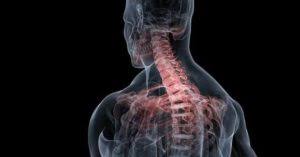 I have treated many patients who had pain between the shoulder blades and were diagnosed with either a cervical herniated disc, stenosis or pinched nerve. C5 C6 Slip Disc Treatment Without Surgery Lasting Relief