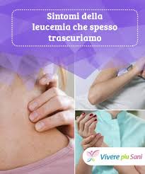 La leucemia è una malattia del sangue in cui il midollo osseo produce un numero maggiore di globuli bianchi o meglio conosciuto come globuli bianchi. Pin Su Curiosita