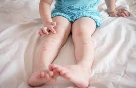Punaise De Lit Quoi Faire Contre Les Punaises De Lit Piqure Insecte Remede Piqure Moustique Punaises De Lit