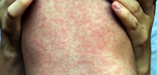 Munculnya ruam merah pada kulit hampir sama dengan gejala campak. 5 Mitos Measles Demam Campak Yang Kita Perlu Tahu Dan Betulkan Zuriat