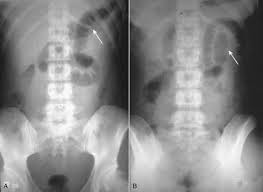Image result for Adynamic Ileus