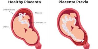 The third trimester of pregnancy can be tiring and uncomfortable. Placenta Previa Or Low Lying Placenta