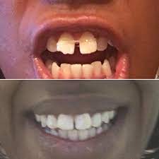Closing gaps in teeth costs anywhere from £200 (for bonding to fill a gap between two front teeth) to thousands of pounds for porcelain veneers or braces. Amazon Com Orthodontic Elastic Gap Teeth Bands Floss Size 1 8 Heavy 100 Bands For Lower Teeth Or Smaller Upper Teeth Tooth Whitening Products Beauty
