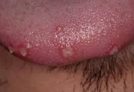 Image result for papillomavirus tongue)
