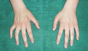 See pictures and get the facts. A Young Woman With Slender Hands Tidsskrift For Den Norske Legeforening