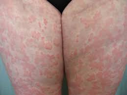 Urticaria Hives Signs Symptoms And Complications