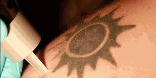 Depending on the size, pigments. How Does Laser Tattoo Removal Work Business Insider