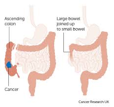 Pin On Cancer Sucks