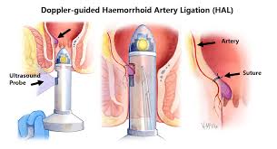 Colon cancer and rectal cancer. Haemorrhoids Colorectal Surgeons Sydney