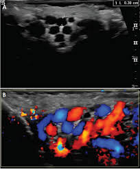 Image result for Varicocele