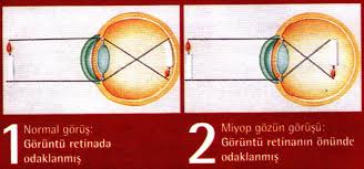 Miyop Ve Hipermetrop Goz Kusurlari Gozdeki Nasil Degisiklikler Sonucu Ortaya Cikar Eodev Com