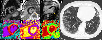Keeping with post covid status and distribution of the fibrosis, the features are in favor of fibrosing stage of disease process. Role Of Advanced Imaging In Covid 19 Cardiovascular Complications Insights Into Imaging Full Text