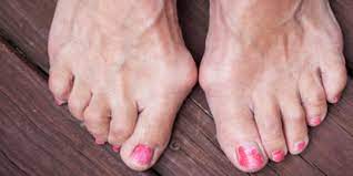 Maybe you would like to learn more about one of these? Terganggu Oleh Bunion Atasi Dengan 2 Terapi Mudah Ini Merdeka Com