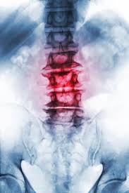 Spondylose Wirbelsaulen Verschleiss Alles Wichtige Dazu Liebscher Bracht