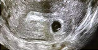 Rahim kanseri hayatta kalma süreleri şöyledir; Kanser Ultrasonda Belli Olurmu