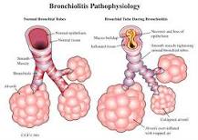 Image result for icd 10 code for acute bronchitis due to rhinovirus