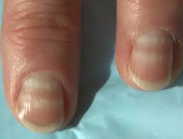 There are a number of nail changes, though, that can signal an underlying medical problem. White Nail Dermnet Nz