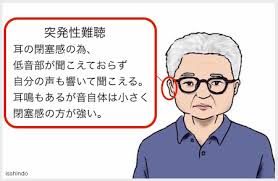 突発性難聴（とっぱつせいなんちょう、英名：sudden deafness（sd）もしくはsudden sensorineural hearing loss（sshl））とは突発的におきる原因不明の急性感音難聴である。突発的な発症が特徴であり. çªç™ºæ€§é›£è´ã¸ã®é¼ç¸æ²»ç™‚