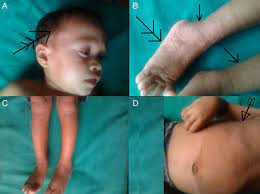 Sjogren Larsson Syndrome A Rare Disease Of The Skin And Central Nervous System Bmj Case Reports