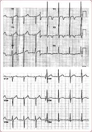 The ecg in mitral stenosis is often normal early in disease. Ecg Changes Acute Cardiogenic Pulmonary Edema With Preserved Left Download Scientific Diagram