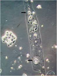 Image result for Urinary Cast