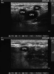 A 12v 10w maximum bipin g4 base quartz halogen lamp is standard. Ultrasound Part Ii Clinical Emergency Radiology