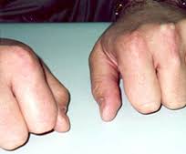 Image result for Hypercholesterolemia